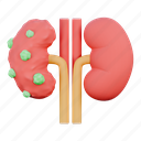 kidneys, tumor, illness, anatomy, nefrolitiasis, body, organ, cancer