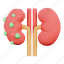kidneys, tumor, illness, anatomy, nefrolitiasis, body, organ, cancer 