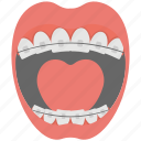 braces, dental braces, mouth, orthodontics, teeth