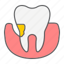 tooth, periodontitis, stomatology, disease, plaque, dental, periodontal