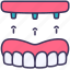 dental, dentures, full, implant, screw, tooth 
