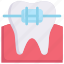 brace, bracket, dental care, dentist, health, orthodontic, tooth 
