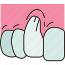 gum, receding, periodontal, dental, disease