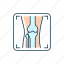 arthritis x ray, osteoarthritis, radiology 